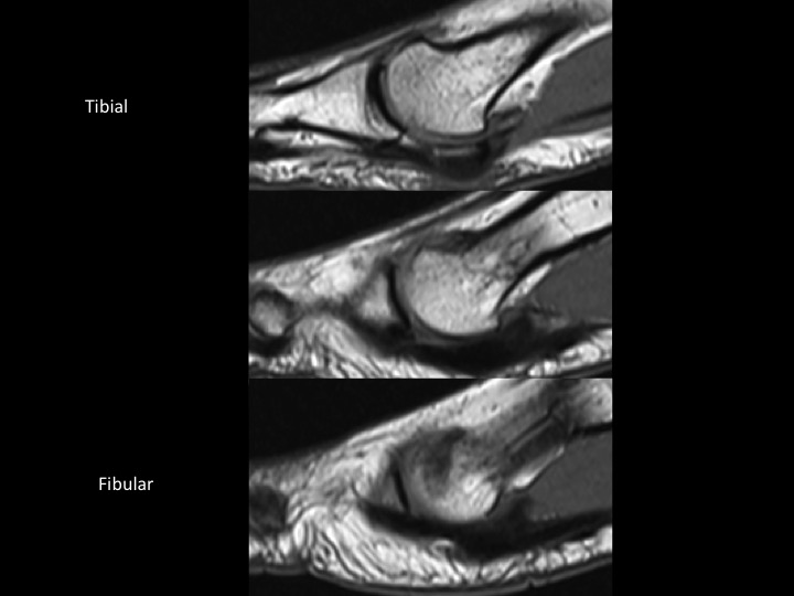 Figure 3 for case fibular sesamoid of metatarsal head ( RID2990 )